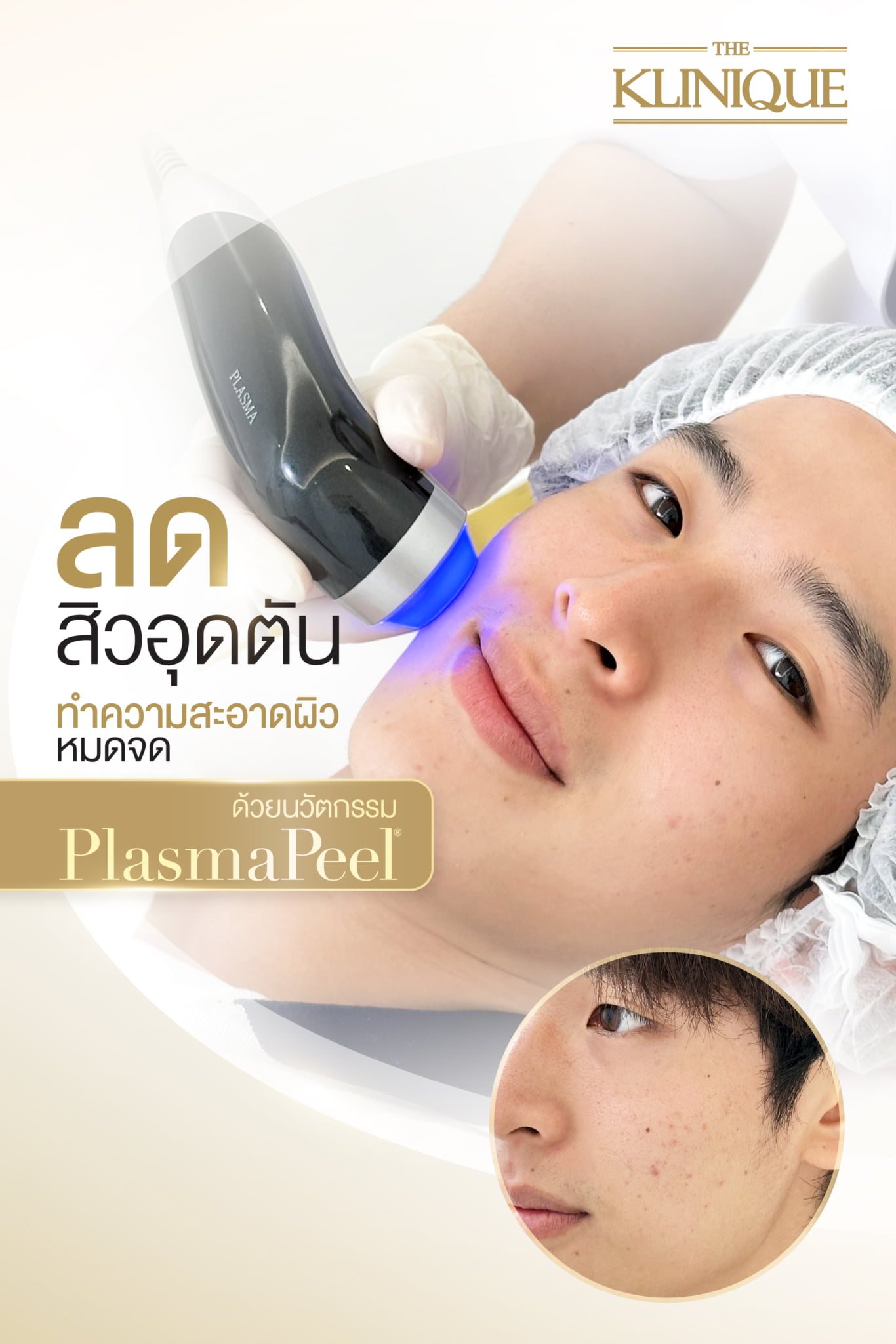 ลดสิวอุดตัน ทำความสะอาดผิวหมดจดด้วยนวัตกรรม Plasma Peel - Theklinique