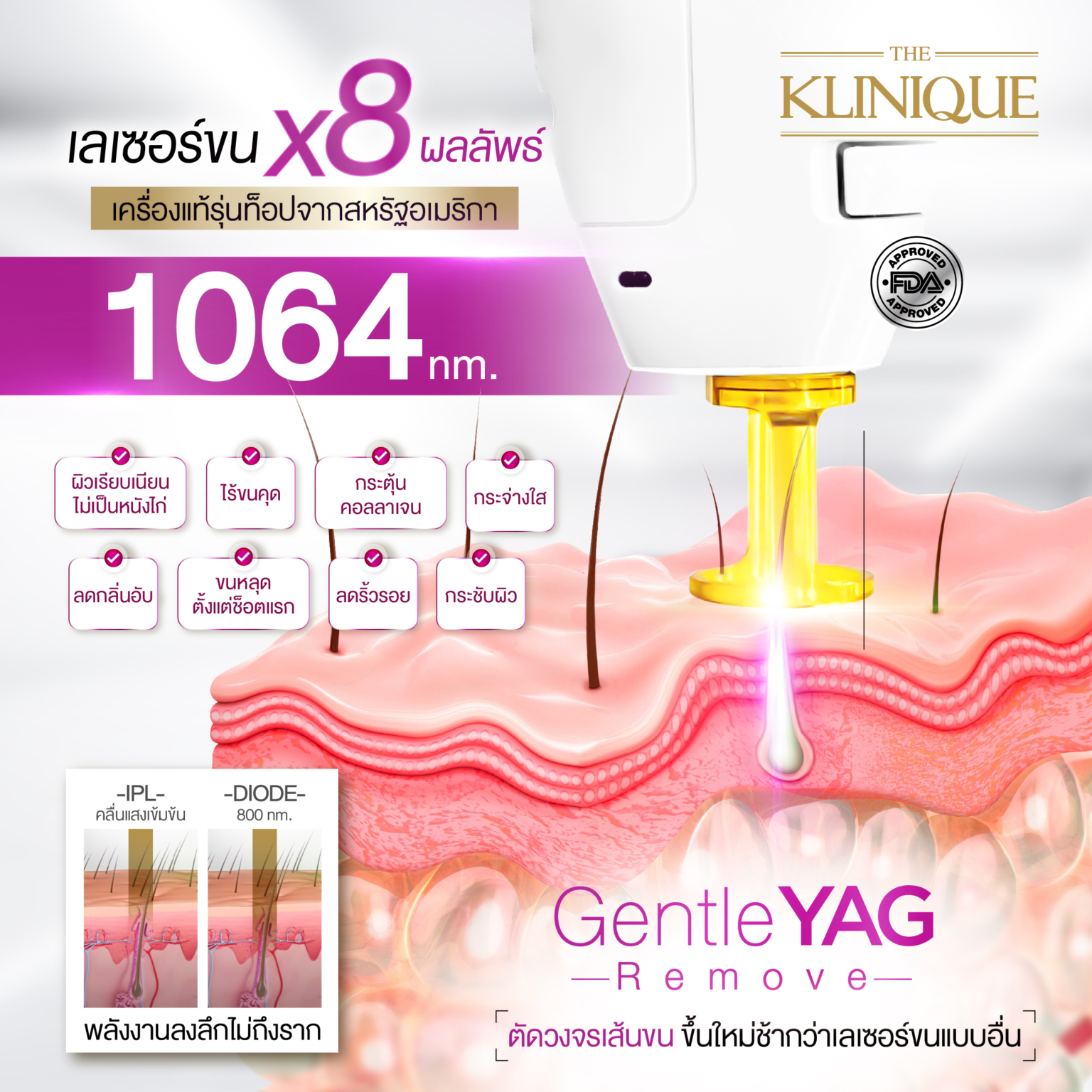 รีวิวเลเซอร์ขนน้องสาว กำจัดขนน้องสาวอย่างอ่อนโยนด้วย Gentle Yag Remove Theklinique