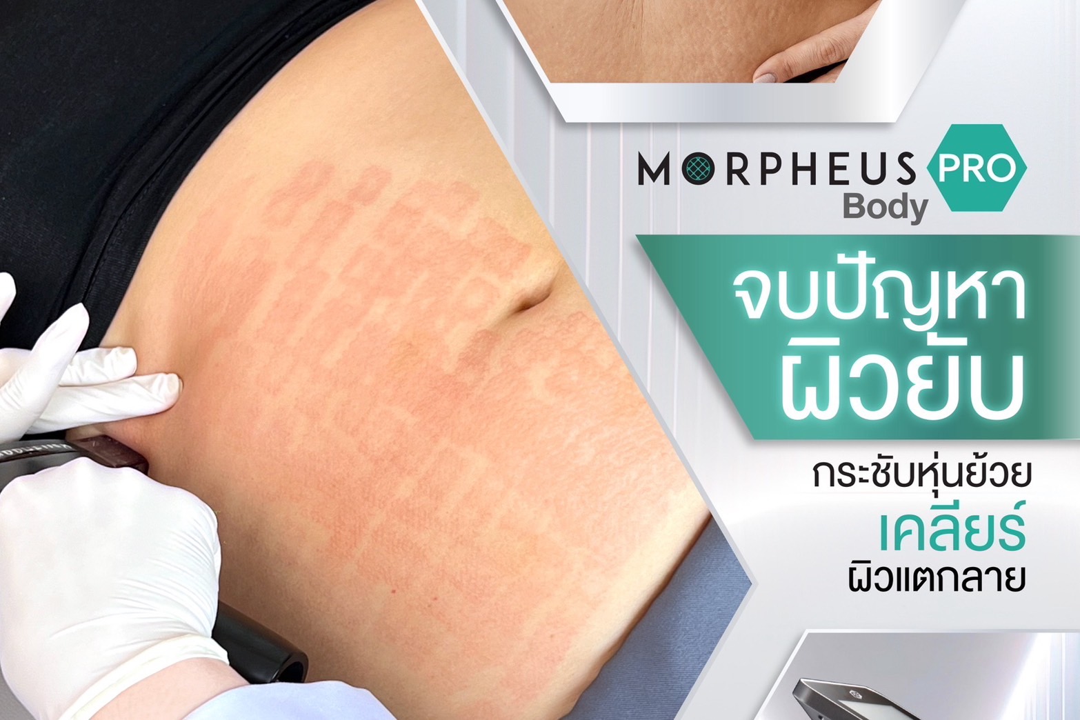 Morpheus PRO Body จบปัญหาผิวยับ กระชับหุ่นย้วย เคลียร์ผิวแตกลาย ...