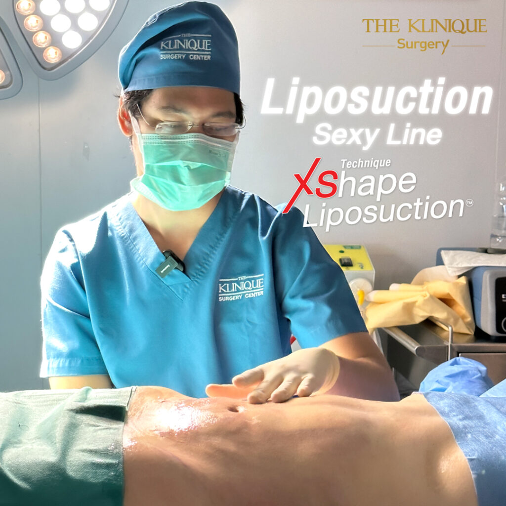 Liposuction, Sculpting,Xshape,Lipo, ศัลยกรรมดูดไขมัน, ดูดไขมัน,คลินิกดูดไขมัน,ดูดไขมันเฉพาะส่วน,ดูดไขมันเหนียง,ดูดไขมันหน้าท้อง,ดูดไขมันรีวิว, รีวิวดูดไขมัน, รีวิวดูดไขมันหน้าท้อง,ดูดไขมันต้นแขน, ดูดไขมันต้นขา,ดูดไขมันน่อง, ลดความอ้วน, ดูดไขมันที่ไหนดี, ดูดไขมันราคา, ดูดไขมันทั้งตัว