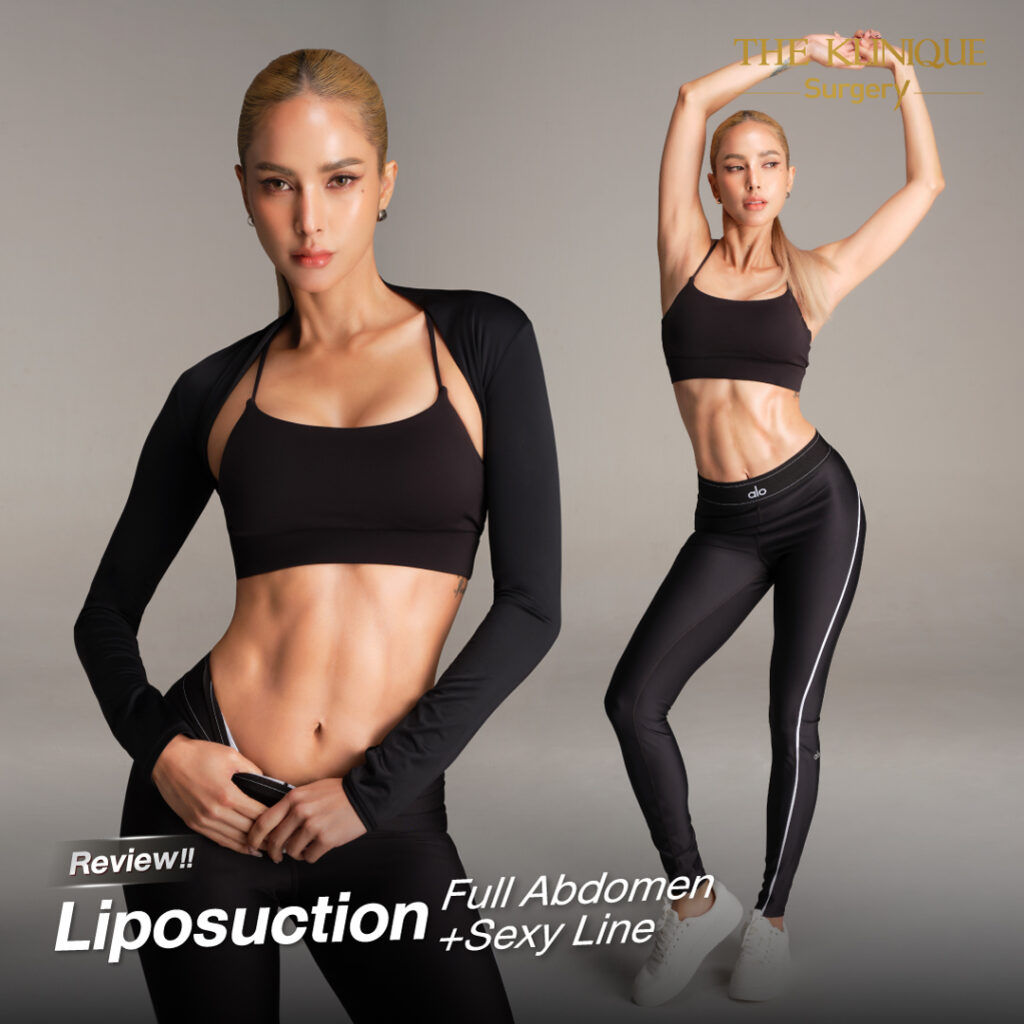 Liposuction, Sculpting,Xshape,Lipo, ศัลยกรรมดูดไขมัน, ดูดไขมัน,คลินิกดูดไขมัน,ดูดไขมันเฉพาะส่วน,ดูดไขมันเหนียง,ดูดไขมันหน้าท้อง,ดูดไขมันรีวิว, รีวิวดูดไขมัน, รีวิวดูดไขมันหน้าท้อง,ดูดไขมันต้นแขน, ดูดไขมันต้นขา,ดูดไขมันน่อง, ลดความอ้วน, ดูดไขมันที่ไหนดี, ดูดไขมันราคา, ดูดไขมันทั้งตัว