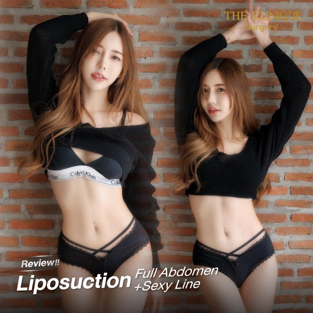 Liposuction, Sculpting,Xshape,Lipo, ศัลยกรรมดูดไขมัน, ดูดไขมัน,คลินิกดูดไขมัน,ดูดไขมันเฉพาะส่วน,ดูดไขมันเหนียง,ดูดไขมันหน้าท้อง,ดูดไขมันรีวิว, รีวิวดูดไขมัน, รีวิวดูดไขมันหน้าท้อง,ดูดไขมันต้นแขน, ดูดไขมันต้นขา,ดูดไขมันน่อง, ลดความอ้วน, ดูดไขมันที่ไหนดี, ดูดไขมันราคา, ดูดไขมันทั้งตัว