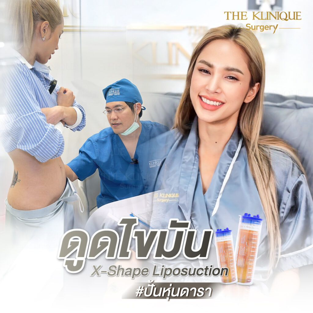 Liposuction, Sculpting,Xshape,Lipo, ศัลยกรรมดูดไขมัน, ดูดไขมัน,คลินิกดูดไขมัน,ดูดไขมันเฉพาะส่วน,ดูดไขมันเหนียง,ดูดไขมันหน้าท้อง,ดูดไขมันรีวิว, รีวิวดูดไขมัน, รีวิวดูดไขมันหน้าท้อง,ดูดไขมันต้นแขน, ดูดไขมันต้นขา,ดูดไขมันน่อง, ลดความอ้วน, ดูดไขมันที่ไหนดี, ดูดไขมันราคา, ดูดไขมันทั้งตัว