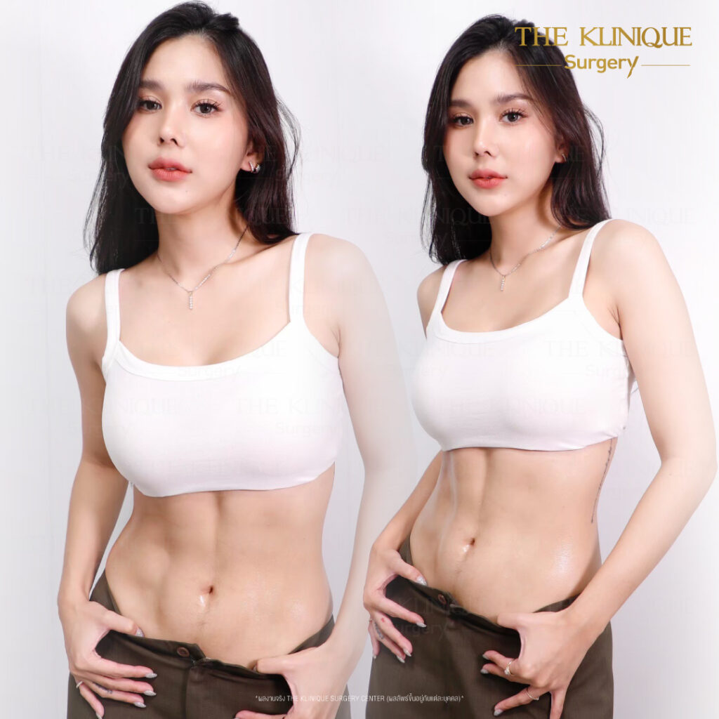 Liposuction, Sculpting,Xshape,Lipo, ศัลยกรรมดูดไขมัน, ดูดไขมัน,คลินิกดูดไขมัน,ดูดไขมันเฉพาะส่วน,ดูดไขมันเหนียง,ดูดไขมันหน้าท้อง,ดูดไขมันรีวิว, รีวิวดูดไขมัน, รีวิวดูดไขมันหน้าท้อง,ดูดไขมันต้นแขน, ดูดไขมันต้นขา,ดูดไขมันน่อง, ลดความอ้วน, ดูดไขมันที่ไหนดี, ดูดไขมันราคา, ดูดไขมันทั้งตัว