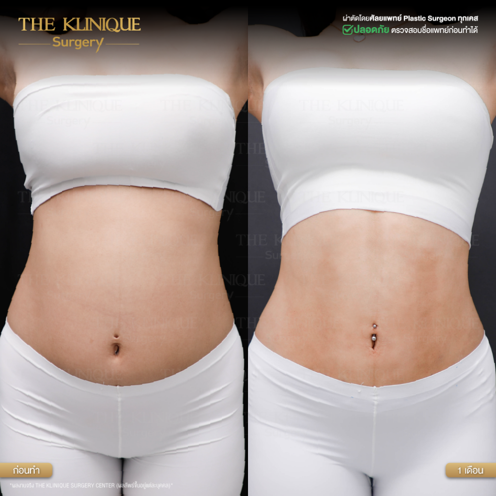 Liposuction, Sculpting,Xshape,Lipo, ศัลยกรรมดูดไขมัน, ดูดไขมัน,คลินิกดูดไขมัน,ดูดไขมันเฉพาะส่วน,ดูดไขมันเหนียง,ดูดไขมันหน้าท้อง,ดูดไขมันรีวิว, รีวิวดูดไขมัน, รีวิวดูดไขมันหน้าท้อง,ดูดไขมันต้นแขน, ดูดไขมันต้นขา,ดูดไขมันน่อง, ลดความอ้วน, ดูดไขมันที่ไหนดี, ดูดไขมันราคา, ดูดไขมันทั้งตัว