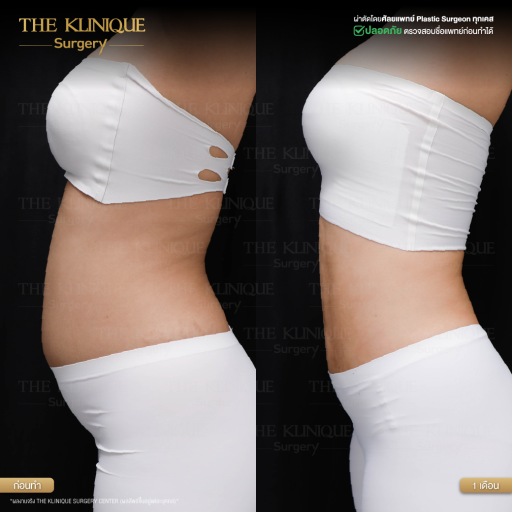 Liposuction, Sculpting,Xshape,Lipo, ศัลยกรรมดูดไขมัน, ดูดไขมัน,คลินิกดูดไขมัน,ดูดไขมันเฉพาะส่วน,ดูดไขมันเหนียง,ดูดไขมันหน้าท้อง,ดูดไขมันรีวิว, รีวิวดูดไขมัน, รีวิวดูดไขมันหน้าท้อง,ดูดไขมันต้นแขน, ดูดไขมันต้นขา,ดูดไขมันน่อง, ลดความอ้วน, ดูดไขมันที่ไหนดี, ดูดไขมันราคา, ดูดไขมันทั้งตัว