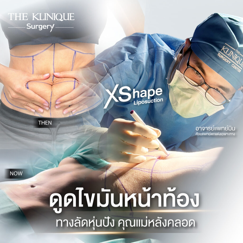 Liposuction, Sculpting,Xshape,Lipo, ศัลยกรรมดูดไขมัน, ดูดไขมัน,คลินิกดูดไขมัน,ดูดไขมันเฉพาะส่วน,ดูดไขมันเหนียง,ดูดไขมันหน้าท้อง,ดูดไขมันรีวิว, รีวิวดูดไขมัน, รีวิวดูดไขมันหน้าท้อง,ดูดไขมันต้นแขน, ดูดไขมันต้นขา,ดูดไขมันน่อง, ลดความอ้วน, ดูดไขมันที่ไหนดี, ดูดไขมันราคา, ดูดไขมันทั้งตัว