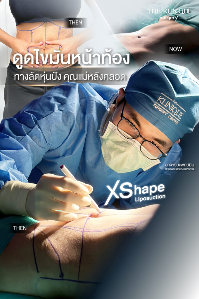 Liposuction, Sculpting,Xshape,Lipo, ศัลยกรรมดูดไขมัน, ดูดไขมัน,คลินิกดูดไขมัน,ดูดไขมันเฉพาะส่วน,ดูดไขมันเหนียง,ดูดไขมันหน้าท้อง,ดูดไขมันรีวิว, รีวิวดูดไขมัน, รีวิวดูดไขมันหน้าท้อง,ดูดไขมันต้นแขน, ดูดไขมันต้นขา,ดูดไขมันน่อง, ลดความอ้วน, ดูดไขมันที่ไหนดี, ดูดไขมันราคา, ดูดไขมันทั้งตัว