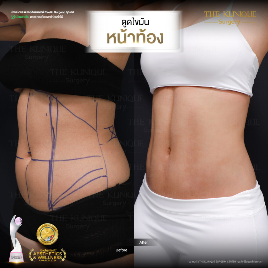 Liposuction, Sculpting,Xshape,Lipo, ศัลยกรรมดูดไขมัน, ดูดไขมัน,คลินิกดูดไขมัน,ดูดไขมันเฉพาะส่วน,ดูดไขมันเหนียง,ดูดไขมันหน้าท้อง,ดูดไขมันรีวิว, รีวิวดูดไขมัน, รีวิวดูดไขมันหน้าท้อง,ดูดไขมันต้นแขน, ดูดไขมันต้นขา,ดูดไขมันน่อง, ลดความอ้วน, ดูดไขมันที่ไหนดี, ดูดไขมันราคา, ดูดไขมันทั้งตัว