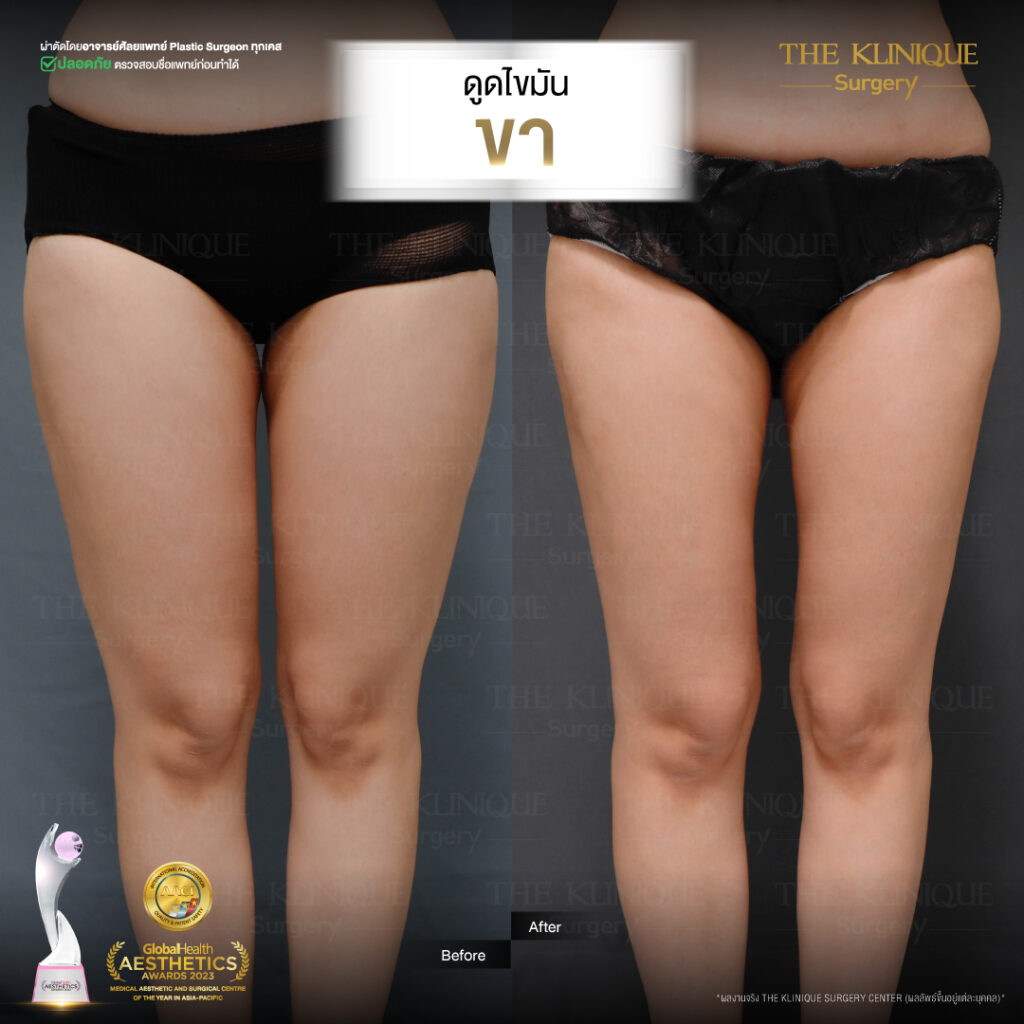 Liposuction, Sculpting,Xshape,Lipo, ศัลยกรรมดูดไขมัน, ดูดไขมัน,คลินิกดูดไขมัน,ดูดไขมันเฉพาะส่วน,ดูดไขมันเหนียง,ดูดไขมันหน้าท้อง,ดูดไขมันรีวิว, รีวิวดูดไขมัน, รีวิวดูดไขมันหน้าท้อง,ดูดไขมันต้นแขน, ดูดไขมันต้นขา,ดูดไขมันน่อง, ลดความอ้วน, ดูดไขมันที่ไหนดี, ดูดไขมันราคา, ดูดไขมันทั้งตัว