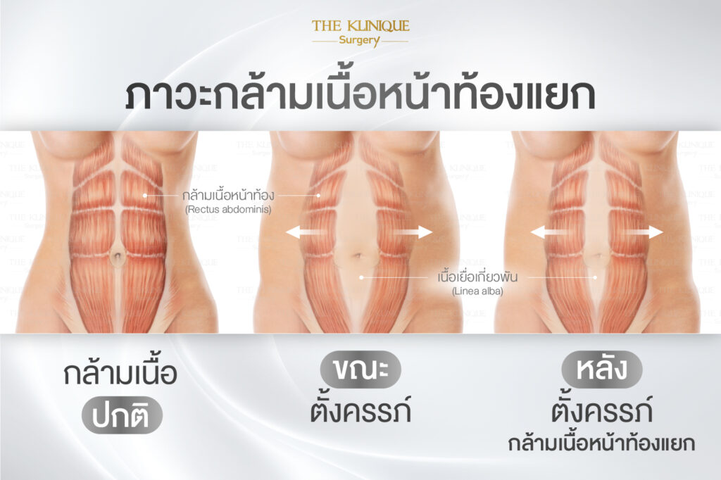 Liposuction, Sculpting,Xshape,Lipo, ศัลยกรรมดูดไขมัน, ดูดไขมัน,คลินิกดูดไขมัน,ดูดไขมันเฉพาะส่วน,ดูดไขมันเหนียง,ดูดไขมันหน้าท้อง,ดูดไขมันรีวิว, รีวิวดูดไขมัน, รีวิวดูดไขมันหน้าท้อง,ดูดไขมันต้นแขน, ดูดไขมันต้นขา,ดูดไขมันน่อง, ลดความอ้วน, ดูดไขมันที่ไหนดี, ดูดไขมันราคา, ดูดไขมันทั้งตัว