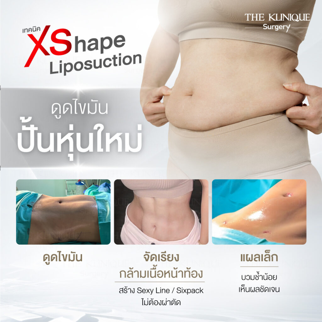 Liposuction, Sculpting,Xshape,Lipo, ศัลยกรรมดูดไขมัน, ดูดไขมัน,คลินิกดูดไขมัน,ดูดไขมันเฉพาะส่วน,ดูดไขมันเหนียง,ดูดไขมันหน้าท้อง,ดูดไขมันรีวิว, รีวิวดูดไขมัน, รีวิวดูดไขมันหน้าท้อง,ดูดไขมันต้นแขน, ดูดไขมันต้นขา,ดูดไขมันน่อง, ลดความอ้วน, ดูดไขมันที่ไหนดี, ดูดไขมันราคา, ดูดไขมันทั้งตัว