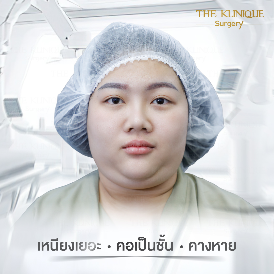 Liposuction, Sculpting,Xshape,Lipo, ศัลยกรรมดูดไขมัน, ดูดไขมัน,คลินิกดูดไขมัน,ดูดไขมันเฉพาะส่วน,ดูดไขมันเหนียง,ดูดไขมันหน้าท้อง,ดูดไขมันรีวิว, รีวิวดูดไขมัน, รีวิวดูดไขมันหน้าท้อง,ดูดไขมันต้นแขน, ดูดไขมันต้นขา,ดูดไขมันน่อง, ลดความอ้วน, ดูดไขมันที่ไหนดี, ดูดไขมันราคา, ดูดไขมันทั้งตัว