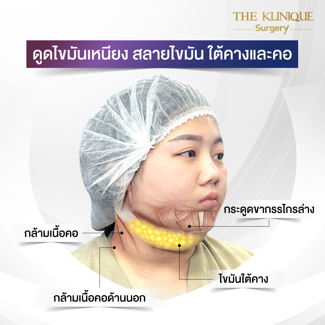 Liposuction, Sculpting,Xshape,Lipo, ศัลยกรรมดูดไขมัน, ดูดไขมัน,คลินิกดูดไขมัน,ดูดไขมันเฉพาะส่วน,ดูดไขมันเหนียง,ดูดไขมันหน้าท้อง,ดูดไขมันรีวิว, รีวิวดูดไขมัน, รีวิวดูดไขมันหน้าท้อง,ดูดไขมันต้นแขน, ดูดไขมันต้นขา,ดูดไขมันน่อง, ลดความอ้วน, ดูดไขมันที่ไหนดี, ดูดไขมันราคา, ดูดไขมันทั้งตัว