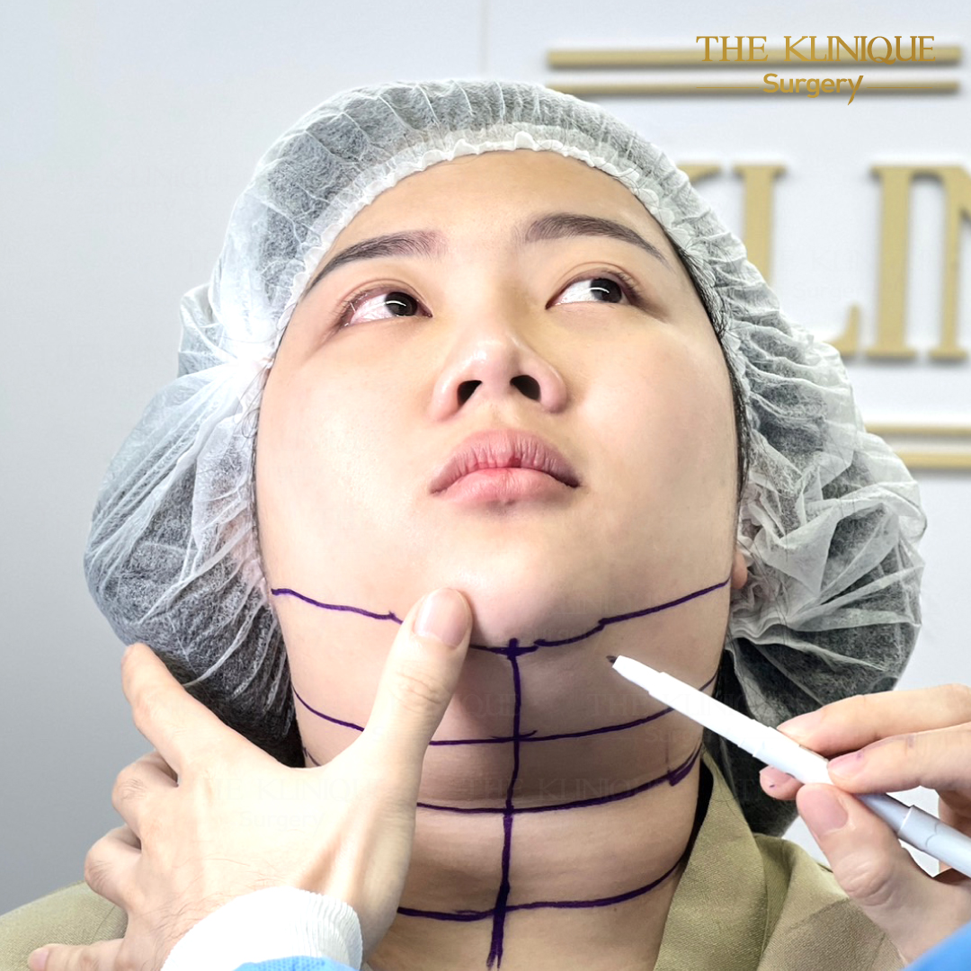 Liposuction, Sculpting,Xshape,Lipo, ศัลยกรรมดูดไขมัน, ดูดไขมัน,คลินิกดูดไขมัน,ดูดไขมันเฉพาะส่วน,ดูดไขมันเหนียง,ดูดไขมันหน้าท้อง,ดูดไขมันรีวิว, รีวิวดูดไขมัน, รีวิวดูดไขมันหน้าท้อง,ดูดไขมันต้นแขน, ดูดไขมันต้นขา,ดูดไขมันน่อง, ลดความอ้วน, ดูดไขมันที่ไหนดี, ดูดไขมันราคา, ดูดไขมันทั้งตัว