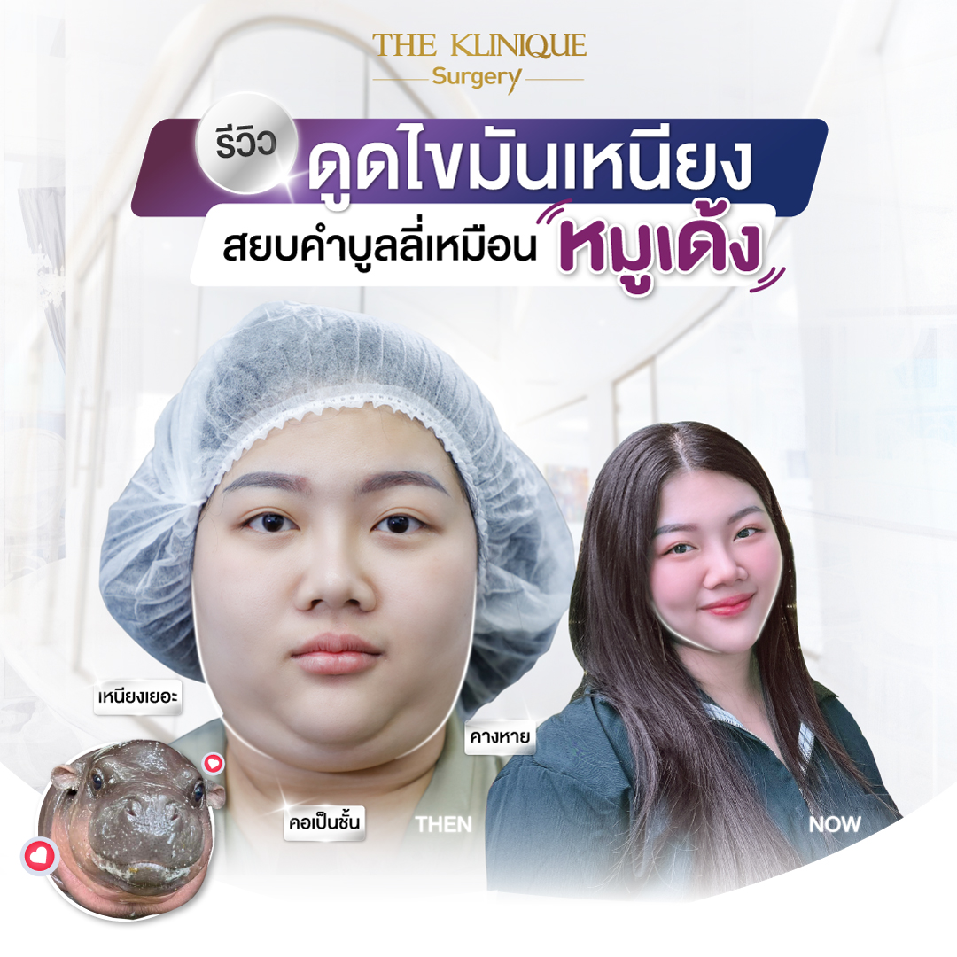 Liposuction, Sculpting,Xshape,Lipo, ศัลยกรรมดูดไขมัน, ดูดไขมัน,คลินิกดูดไขมัน,ดูดไขมันเฉพาะส่วน,ดูดไขมันเหนียง,ดูดไขมันหน้าท้อง,ดูดไขมันรีวิว, รีวิวดูดไขมัน, รีวิวดูดไขมันหน้าท้อง,ดูดไขมันต้นแขน, ดูดไขมันต้นขา,ดูดไขมันน่อง, ลดความอ้วน, ดูดไขมันที่ไหนดี, ดูดไขมันราคา, ดูดไขมันทั้งตัว