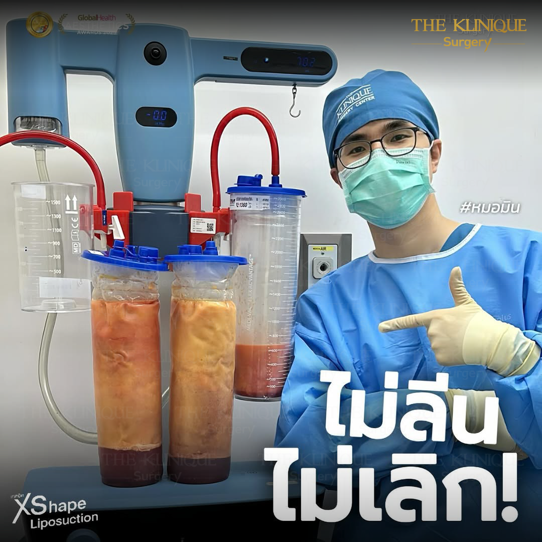 Liposuction, Sculpting,Xshape,Lipo, ศัลยกรรมดูดไขมัน, ดูดไขมัน,คลินิกดูดไขมัน,ดูดไขมันเฉพาะส่วน,ดูดไขมันเหนียง,ดูดไขมันหน้าท้อง,ดูดไขมันรีวิว, รีวิวดูดไขมัน, รีวิวดูดไขมันหน้าท้อง,ดูดไขมันต้นแขน, ดูดไขมันต้นขา,ดูดไขมันน่อง, ลดความอ้วน, ดูดไขมันที่ไหนดี, ดูดไขมันราคา, ดูดไขมันทั้งตัว